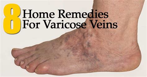 8 Home Remedies For Varicose Veins