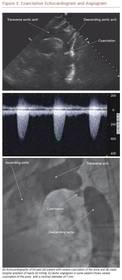 Coarctation Echocardiogram And Angiogram Radcliffe Cardiology
