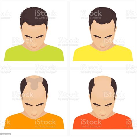 Hair Loss Stages In Men Stock Illustration Download Image Now Adult Arrow Symbol Balding