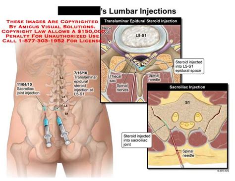 Amicus Illustration Of Amicussugerylumbarinjectionssacroiliacjoint