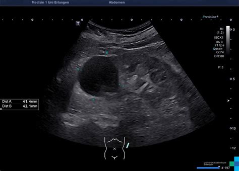 Simple Kidney Cyst Atlas Of Ultrasound