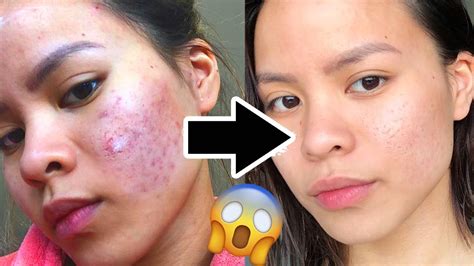 How To Really Get Rid Of Acne Scars Fast Youtube