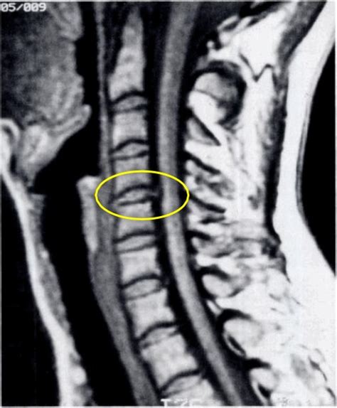 Prevalence Of Cervical Spine Mri Pathology In Asymptomatic Individuals