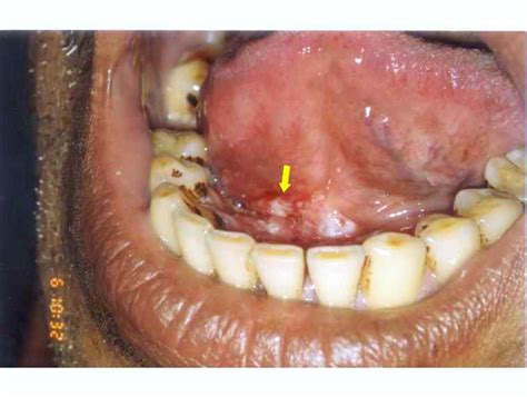 A Digital Manual For The Early Diagnosis Of Oral Neoplasia