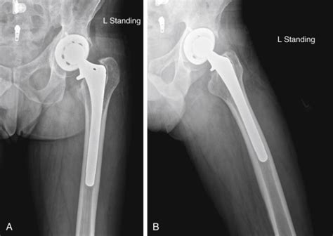 Extended Trochanteric Osteotomy For Femoral Revision Musculoskeletal Key
