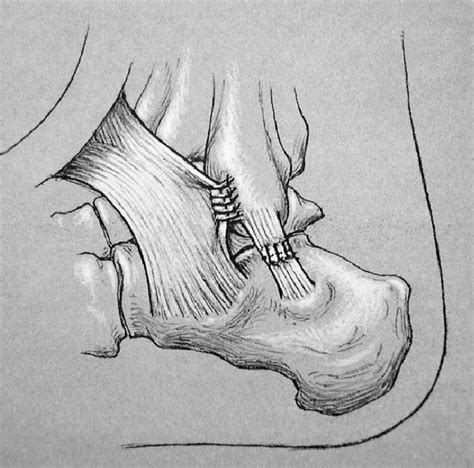 Modified Broström Procedure Drawing Shows Extensor Retinaculum Used To