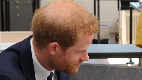 Royal Hair Prince Harry Seeks Help From Clinic As He Starts To Go Bald