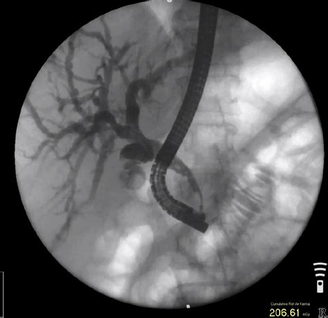 Dilation Assisted Stone Extraction For Complex Biliary Lithiasis