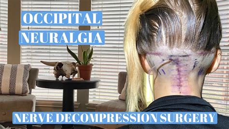 Occipital Neuralgia Nerve Decompression Surgery Recovery Youtube
