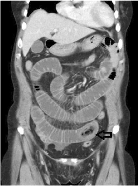Coronary View Of Abdominal Ct Scan Black Arrow Shows The Foreign Body