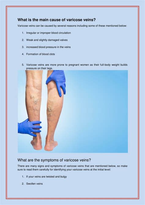 Ppt What Are The Important Facts You Should Know About Varicose Veins Powerpoint Presentation