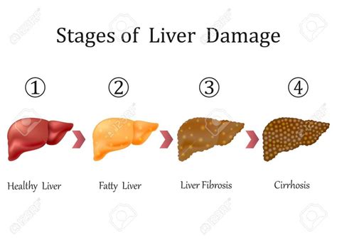 Fatty Liver And Lipotropic Factors Biochemistry Basics By Dr Amit