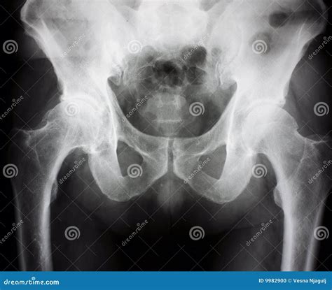X Ray Of The Hips Stock Photo Image 9982900