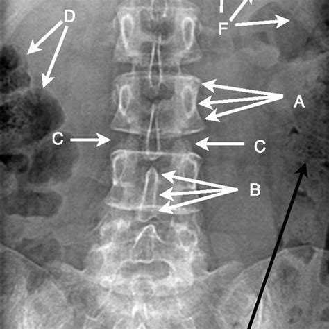 Annotated Ap Lumbar Spine Radiograph A Vertebral Body B Spinous