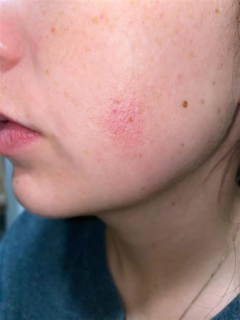 Patch Or Rash Just Popped Up On My Face Randomly I Havent Used