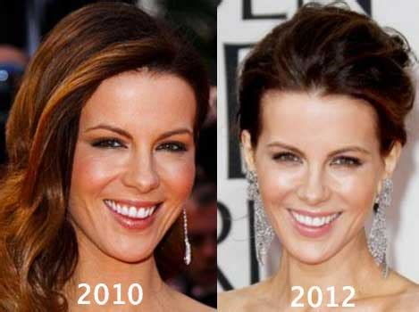 Did Kate Beckinsale Really Have The Plastic Surgery?