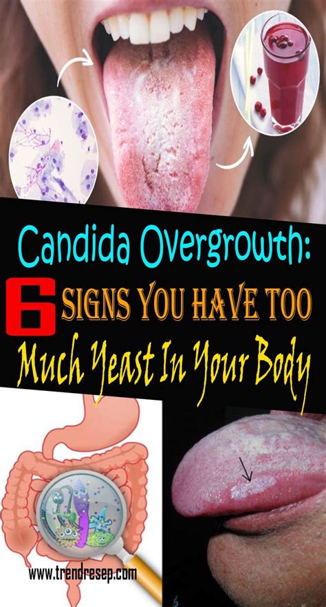 Candida Overgrowth Signs You Have Too Much Yeast In Your Body Candida Overgrowth Candida