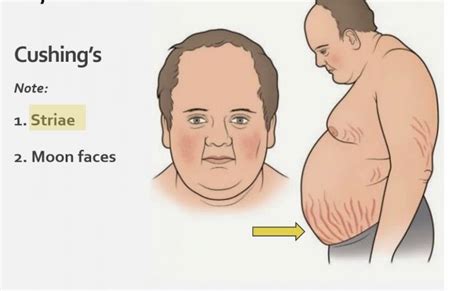 Cushing Syndrome Causes Symptoms And Treatment Updated On October 2023