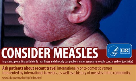 Measles Consider Measles Infographic Cdc