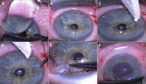 Removal Of Salzmanns Nodule And Amniotic Membrane Placement Springerlink