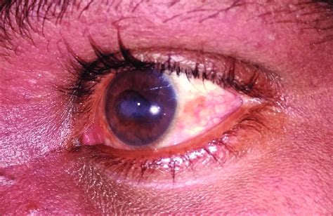 Left Eye Capillary Hemangioma With Proptosis And Band Shaped