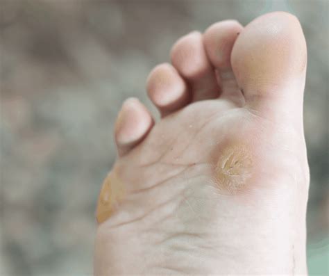 Treatment For Warts In Cary NC Ankle And Foot Doctors