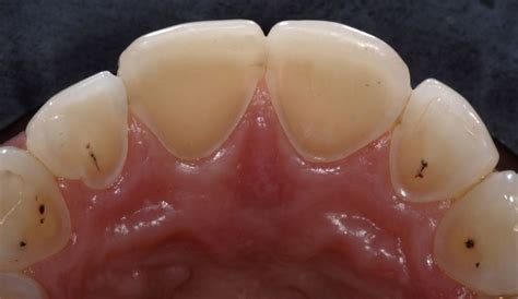 Lingual Veneers A Conservative Approach