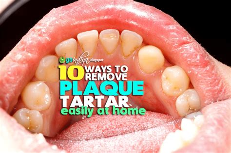 Check spelling or type a new query. 10 Easy Ways to Remove Plaque and Tartar from Teeth At ...