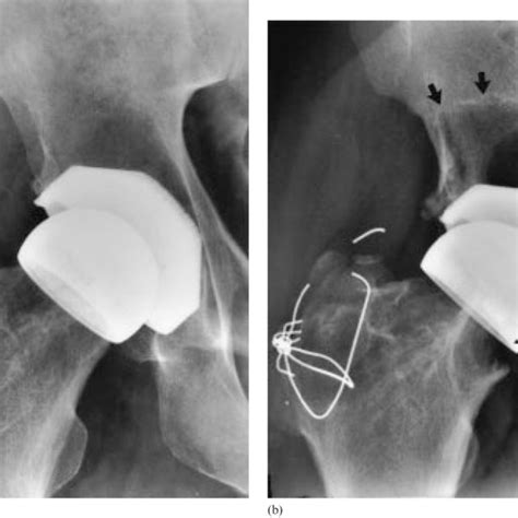 A Antero Posterior Radiograph Of A Right Hip Taken Postoperatively