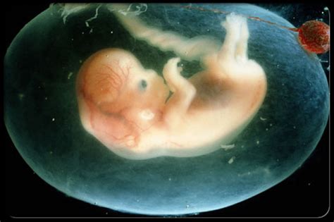 Pectus excavatum occurs in a baby who is developing in the womb. Do Babies Pee inside the Womb? Where does it Go?
