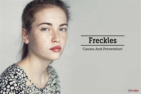 Freckles Causes And Prevention By Dr Dora Chopra Lybrate