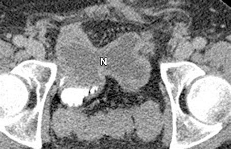 Follow The Stream Imaging Of Urinary Diversions Radiographics