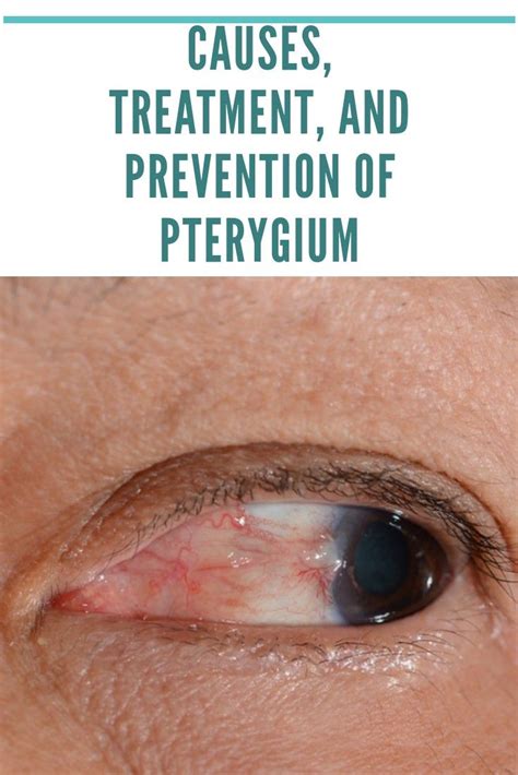 Pterygium Dry Eye Treatment Eyes Problems Treatment