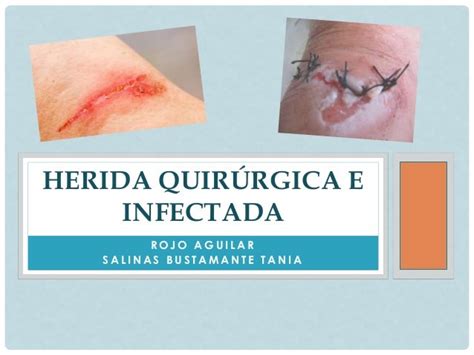 Herida Quirúrgica E Infectada
