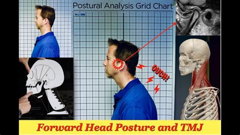 Tmj And Forward Head Posture Youtube
