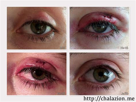 A stye is a red, inflamed bump on the inside or outside of the eyelid. Chalazion.Me | Operación quirúrgica de mi chalazión enquistado