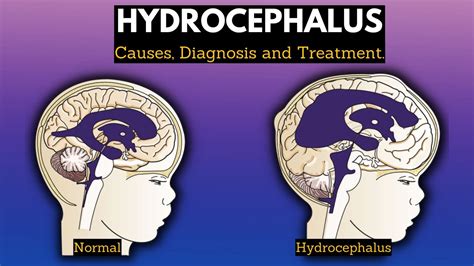 Hydrocephalus Causes Signs And Symptoms Diagnosis And Treatment Youtube