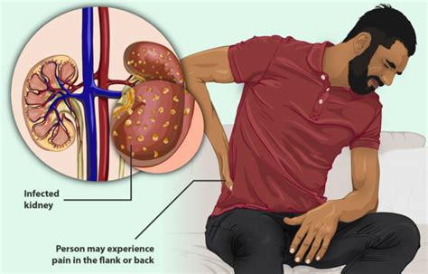 Signs Of A Kidney Infection Wellspire Medical Group