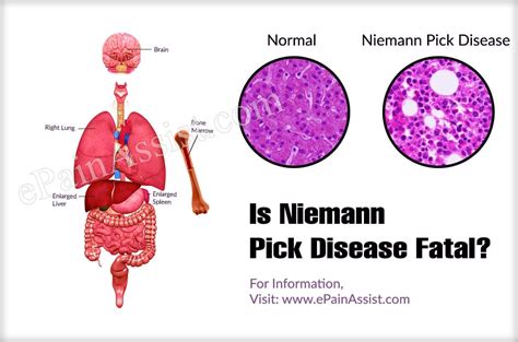 The disease includes a group of conditions characterized by accumulation of sphingomyelin in cells of the body. Is Niemann Pick Disease Fatal & Is It Dominant Or Recessive?