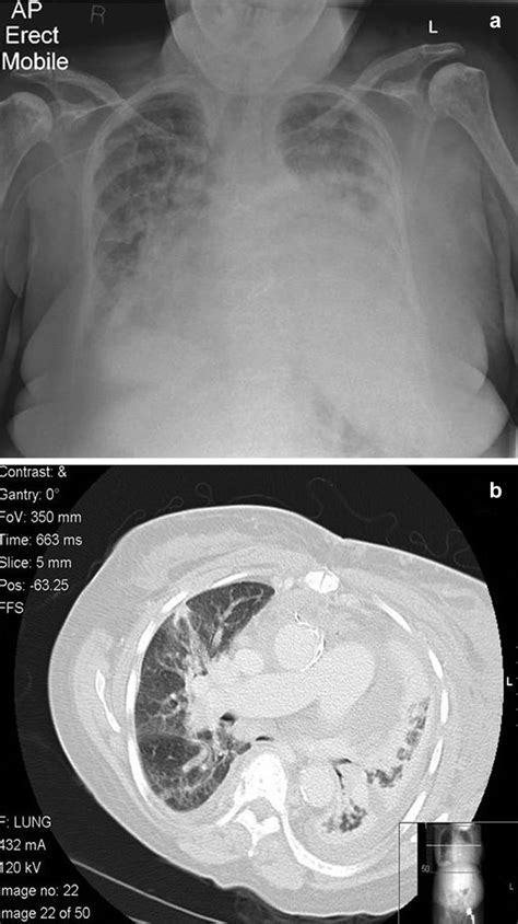 A Cxr Of Patient On Pod 6 Demonstrating Multi Lobar Infiltrates B