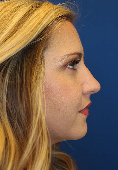 Troy Female Cosmetic Rhinoplasty Before And After Photos Michigan
