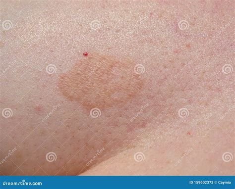 Fungal Rash On Skin 12654 Hot Sex Picture