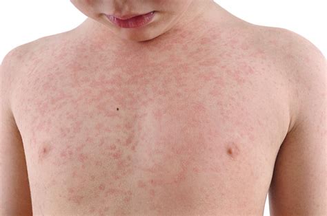 Rubella German Measles Symptoms Treatment During Pregnancy