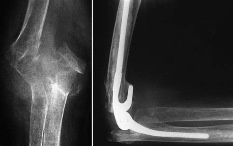 Distal Humerus Fractures Of The Elbow Orthoinfo Aaos 2022