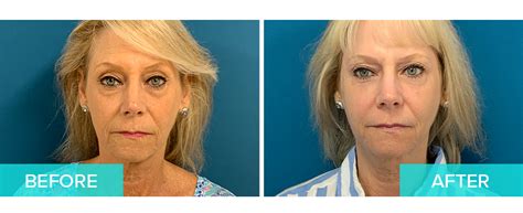 Laser Skin Resurfacing Boca Raton Lasabrasion