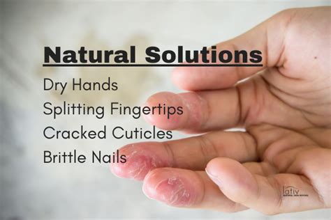 Heal Dry Cracked Hands Tips And Techniques