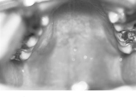 Figure 1 From Surgical Management Of Minor Salivary Gland Neoplasms Of