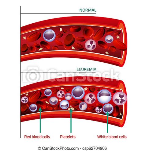 Leukemia Infographic Image Leukemia And Normal Blood Vessel In