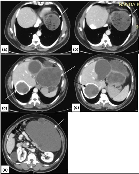 Multiple Hydatid Cysts At Various Stages And One With Complication In