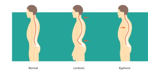 Kyphosis Treatment Causes And Symptoms Qi Spine Clinic